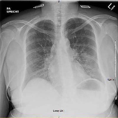 <mark class="highlighted">Clozapine</mark>-Induced Pneumonitis: A Case Report